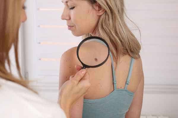 What Are Traditional Skin Lesion Removal Methods West Yorkshire?