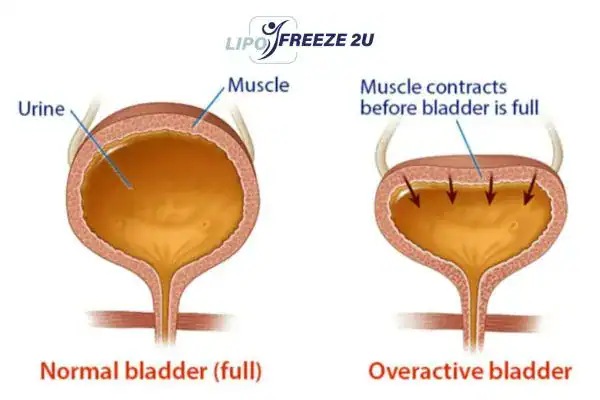 diagram of overactive bladder treatment West Yorkshire
