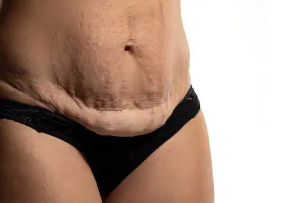 loose skin after weight loss injections West Yorkshire