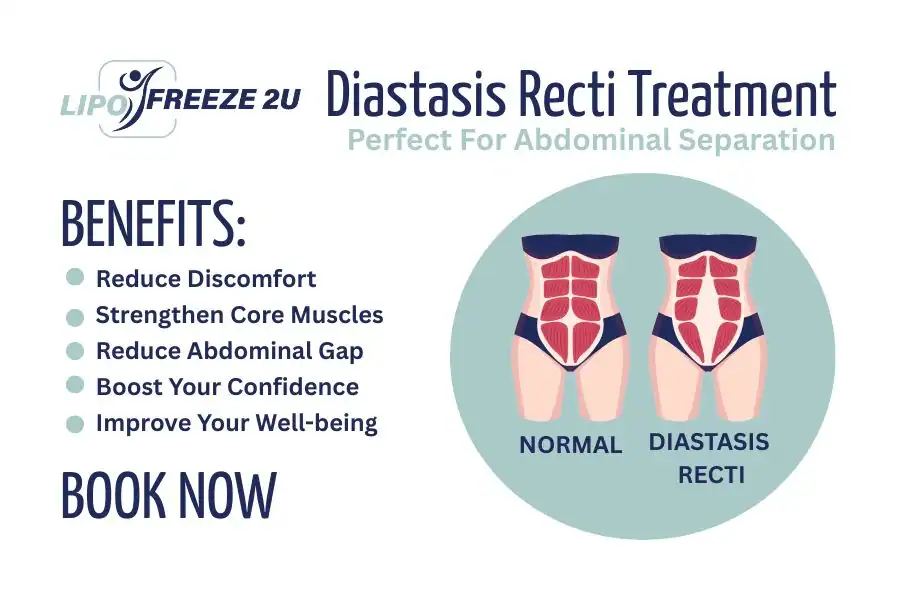 Benefits of body toning treatment West Yorkshire for Diastasis recti