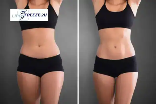 How Can LIPO FREEZE 2U Support Your Post-Pregnancy Body Recovery West Yorkshire?