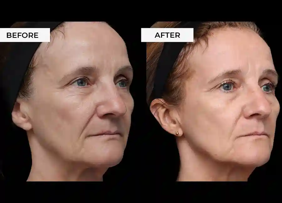 How Many RF Microneedling Sessions Will You Need to See a Difference West Yorkshire?