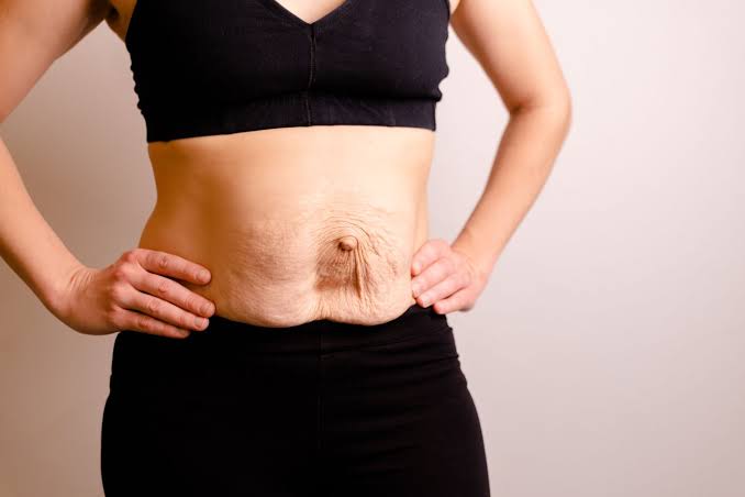 Is Surgery Really the Only Way to Repair Diastasis Recti West Yorkshire?