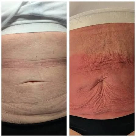 How Does RF Microneedling Improve Crepey, Thin and Uneven Skin Texture West Yorkshire?