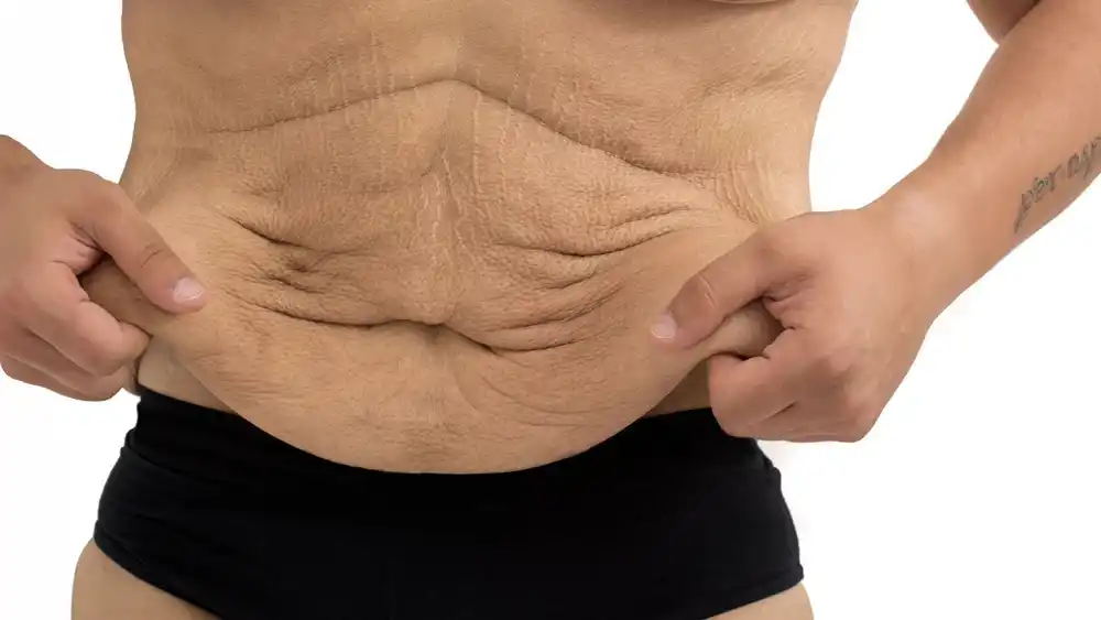 Why Does Weight Loss Medication Leave Some People With Loose or Sagging Skin West Yorkshire?